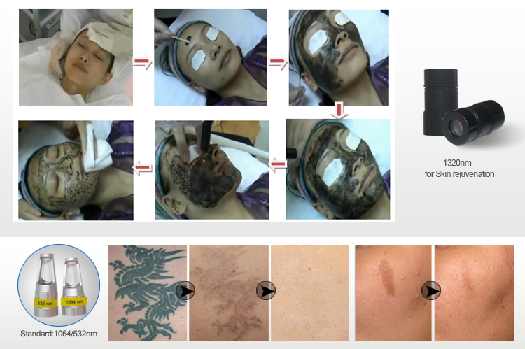 KES factory Big Discount Q Switch Nd Yag Laser Two ND YAG LASER BAR tattoo removal machine MED 810A