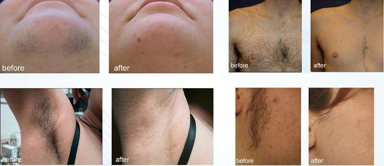Before&After hair removal