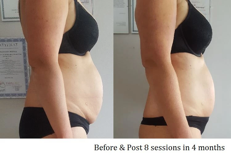 Body Shaping Before After 2