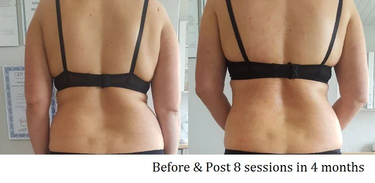 Body Shaping Before After 5