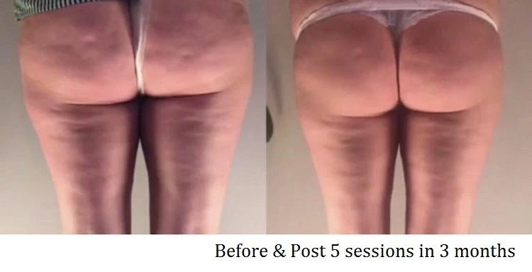 Cellulite Before After 4
