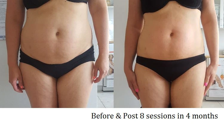 Body Shaping Before After 1