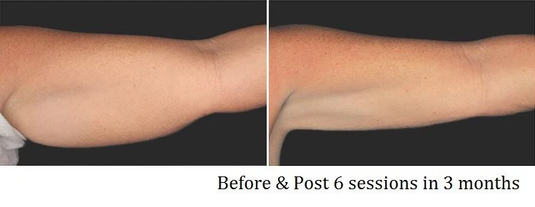 Arm Slim Before After 1