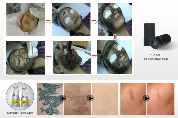 nd yag laser machine nd yag laser machine