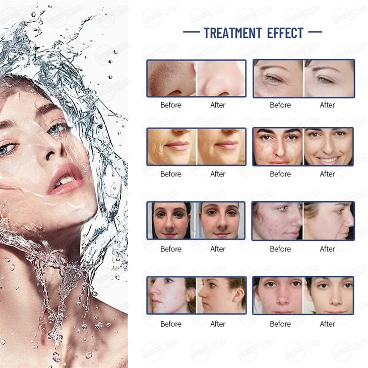 smart ice blue h2o2 facial machine best